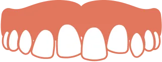 歯が重なってガタガタになった叢生のイラスト
