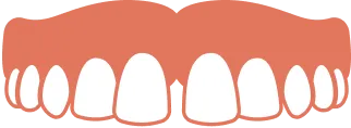 前歯の間に隙間があるすきっ歯のイラスト